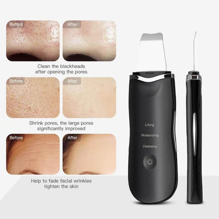 Ultrasonic Facial Skin Scrubber